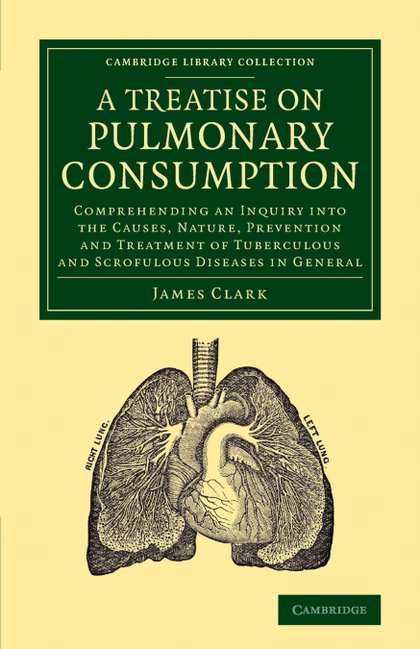 A   TREATISE ON PULMONARY CONSUMPTION